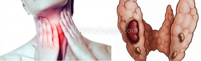 Что такое очаговые образования щитовидной железы?