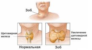 Диффузные изменения щитовидной железы: симптомы и лечение