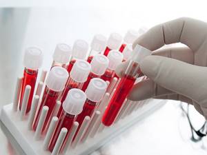 Подготовка к анализу ПСА: как правильно сдать кровь на ПСА общий и свободный, расшифровка результатов