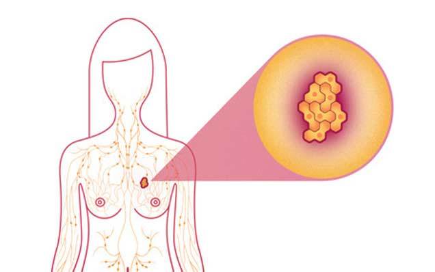 Инвазивный рак молочной железы: симптомы, лечение и прогноз