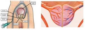 Эмболизация артерий простаты в лечении аденомы простаты