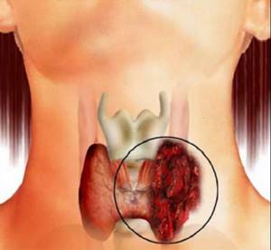 Медуллярный рак щитовидной железы - причины, симптомы, диагностика и лечение