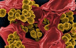 Бактериальный простатит: признаки, возбудители, причины, симптомы. Как лечить хронический бактериальный простатит?