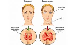 гиперфункция щитовидной железы (гипертиреоз): симптомы у женщин и лечение