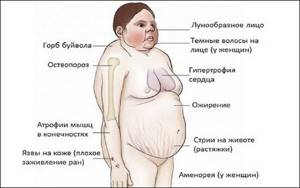 Симптомы различных заболеваний гипоталамуса