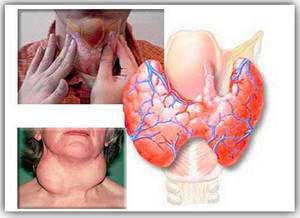 Воспаление щитовидной железы у женщин: причины, симптомы и лечение