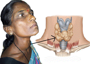 Многоузловой зоб щитовидной железы - симптомы и лечение, что это такое?