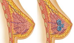 Инвазивный рак молочной железы: симптомы, лечение и прогноз