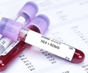 Онкомаркер на рак яичников: СА125, НЕ4, Индекс Рома (roma)
