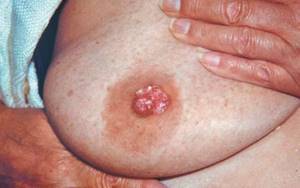 Рак Педжета: симптомы патологии молочной железы, стадии, лечение, прогноз