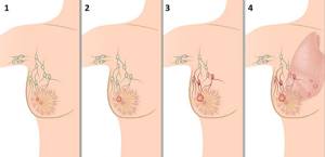 Гормонозависимый рак молочной железы: стадии заболевания и прогноз, лечение