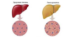 Гемохромaтоз печени - причины, симптомы, диагностика и лечение