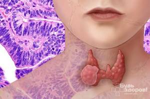 Метастазы рака щитовидной железы симптомы, обнаружение, лечение, прогноз