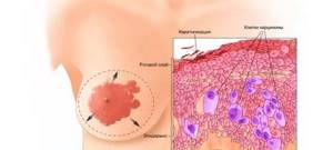 Рак Педжета: симптомы патологии молочной железы, стадии, лечение, прогноз