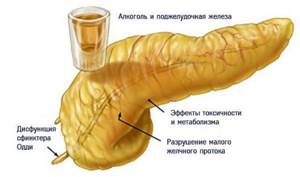 Алкогольный панкреатит - причины, симптомы, диагностика и лечение