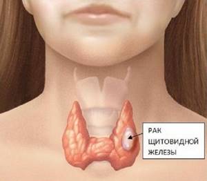 Удаление щитовидной железы: последствия у женщин