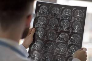 Киста гипофиза головного мозга: симптомы, лечение и последствия
