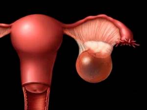Каутеризация яичников: что это такое и как проводится, беременность