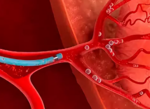 Эмболизация артерий простаты в лечении аденомы простаты