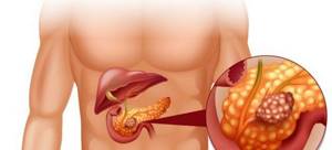 Липоматоз поджелудочной железы: признаки, развитие болезни и лечение