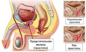Какие опухоли предстательной железы у мужчин бывают