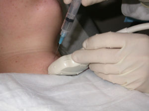 Пункция щитовидной железы: что это такое и что она показывает
