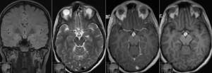 Увеличение гипофиза головного мозга: причины и симптомы