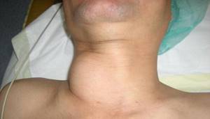 Васкуляризация щитовидной железы услиена или повышена - что это значит